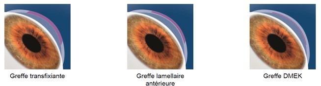Différentes techniques de greffe de cornée