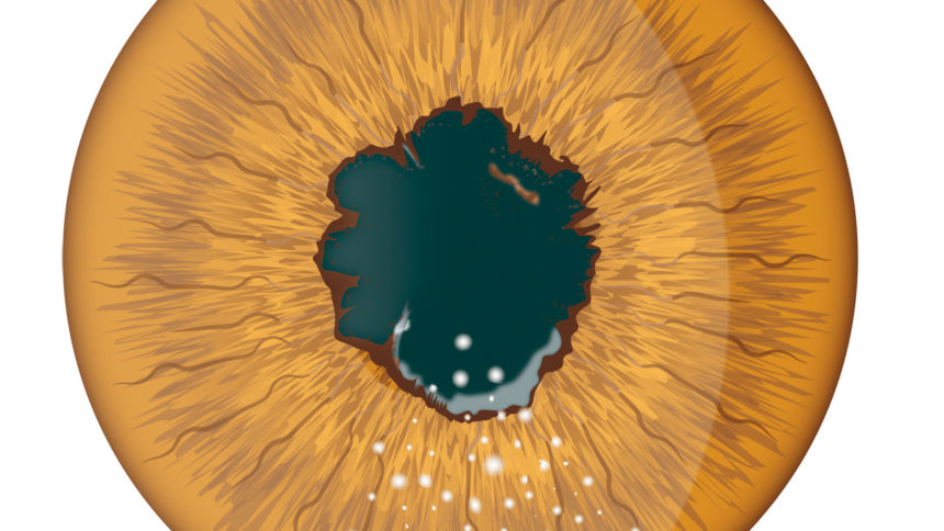 uvéite