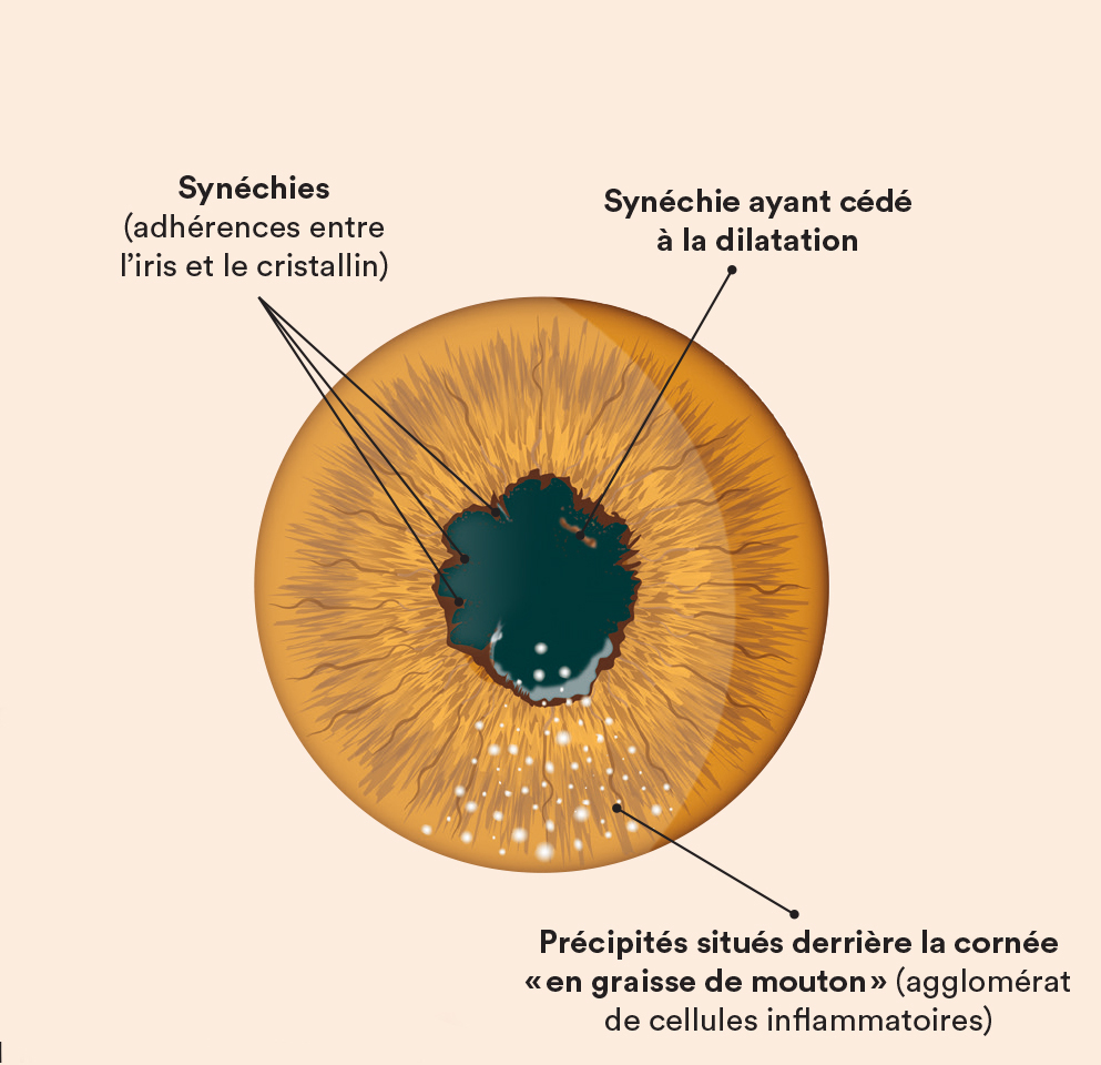 uvéite
